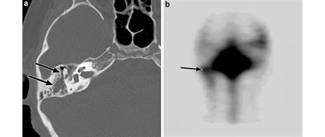 csf leaking from ears|Cerebrospinal Fluid Leaks: A Guide for the Comprehensive ...